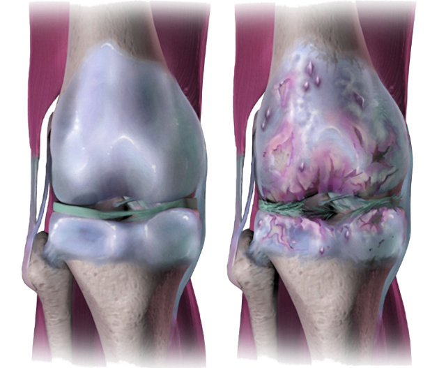 Les huiles essentielles et végétale contre l'arthrite, l'arthrose et les rhumatismes
